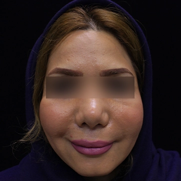 لیپو غبغب قبل