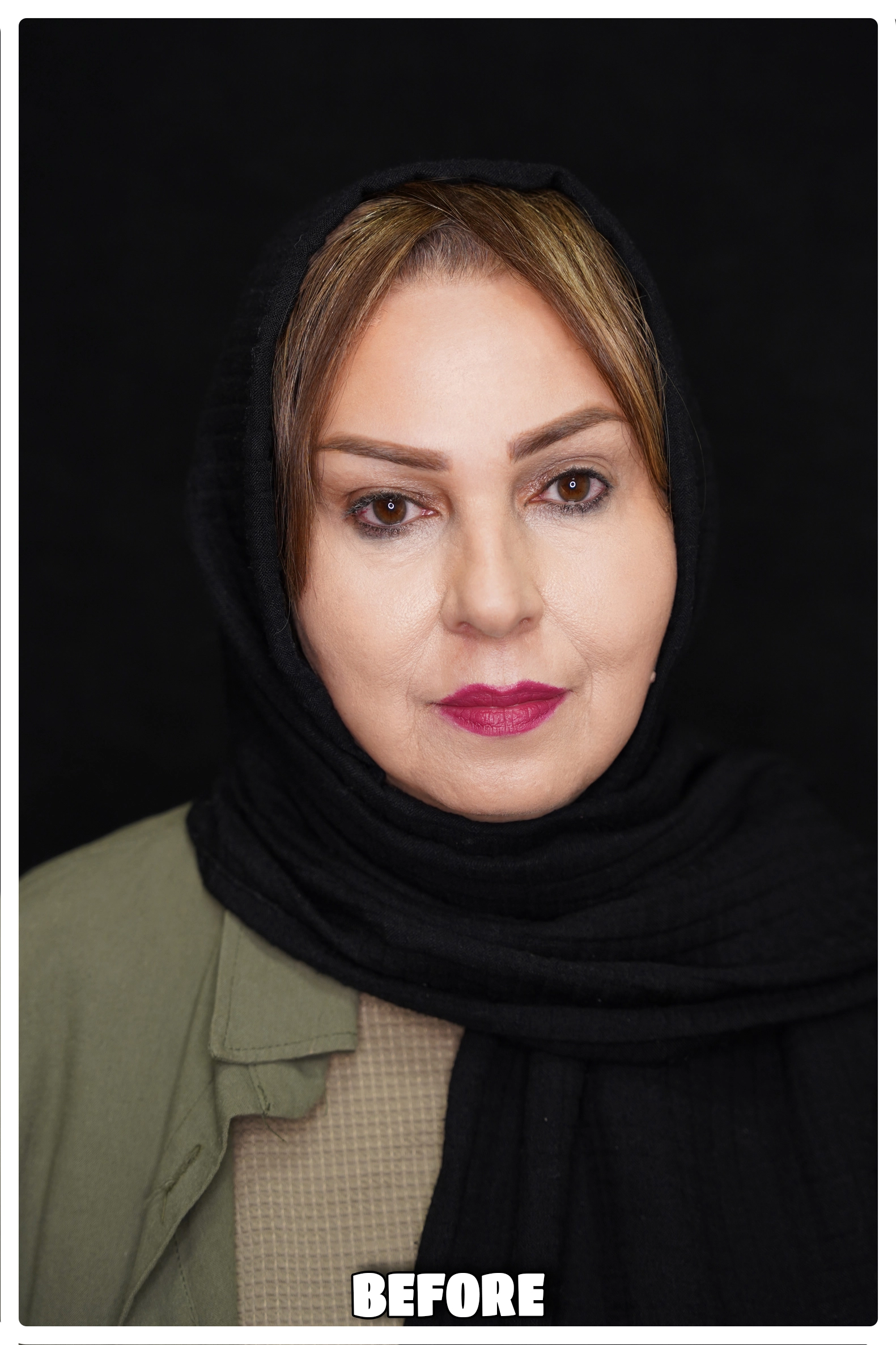 لیفت ابرو به روش اندوسکوپیک