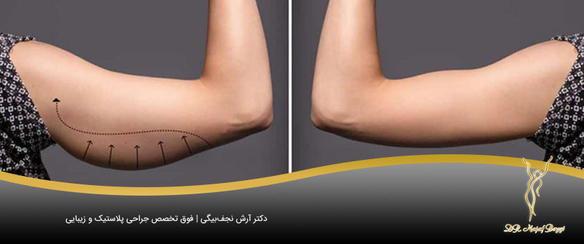 عمل جراحی لیپوماتیک بازو